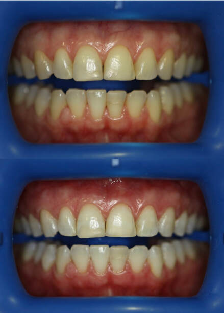 Teeth whitening at Courtney Dental