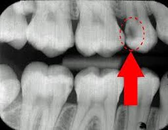 Decay between teeth
