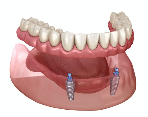 animation of implant retained dentures