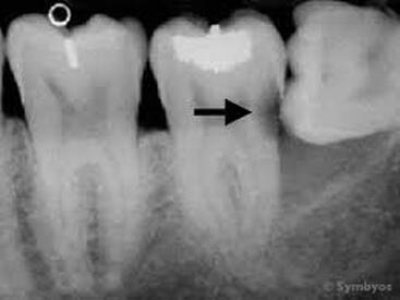 Impacted wisdom tooth with decay
